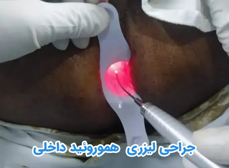 جراحی لیزری CO2 همورویید