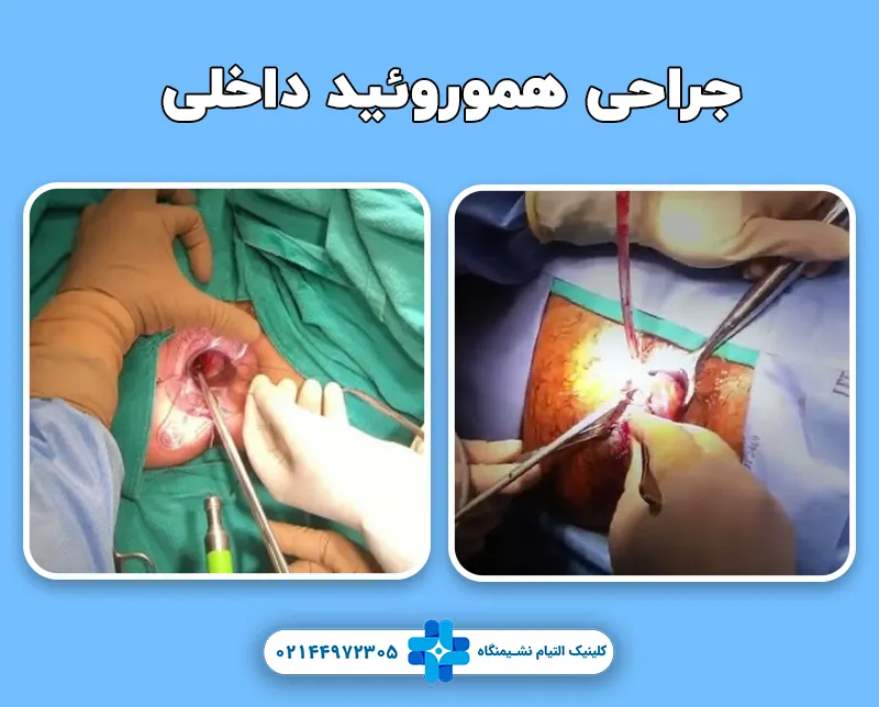 جراحی هموروئید داخلی