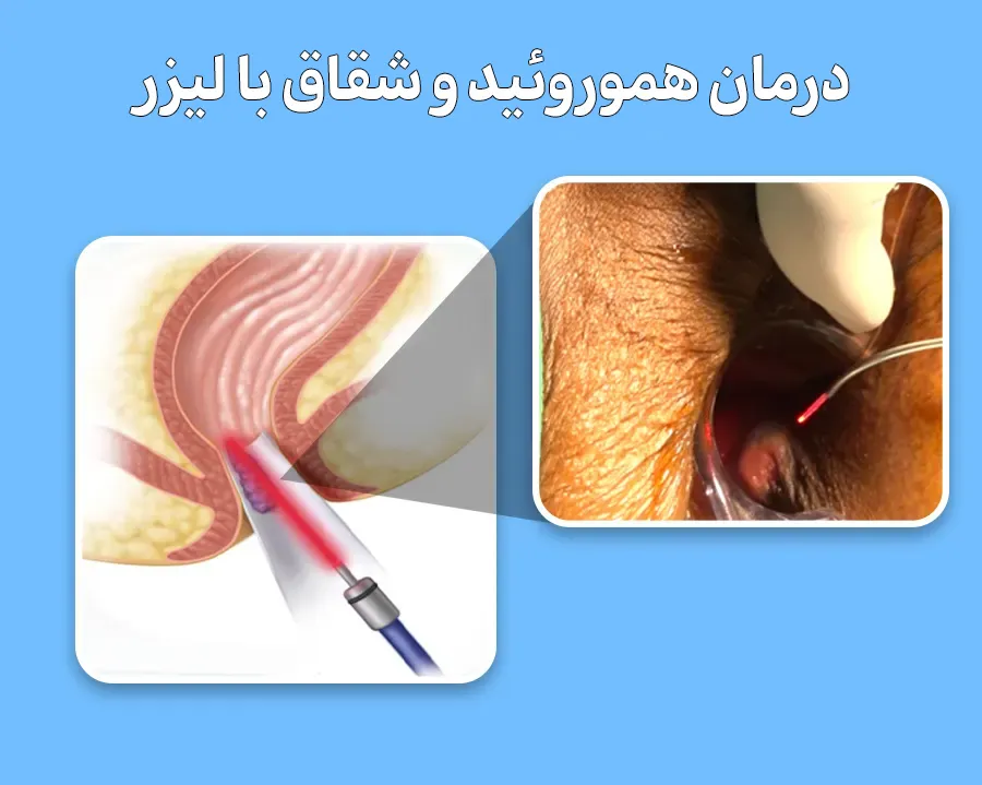 لیزر همورویید و شقاق