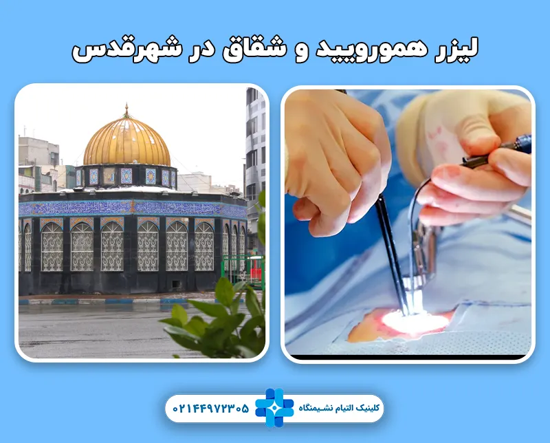 لیزر همورویید و شقاق شهرقدس
