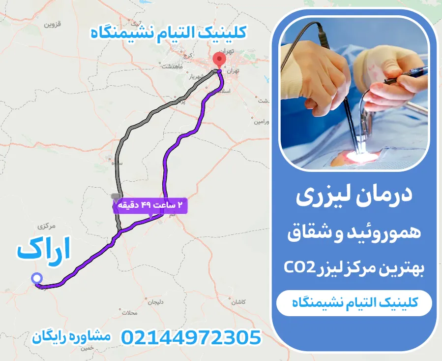 لیزر هموروئید در اراک