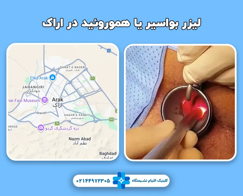 لیزر بواسیر یا هموروئید در اراک