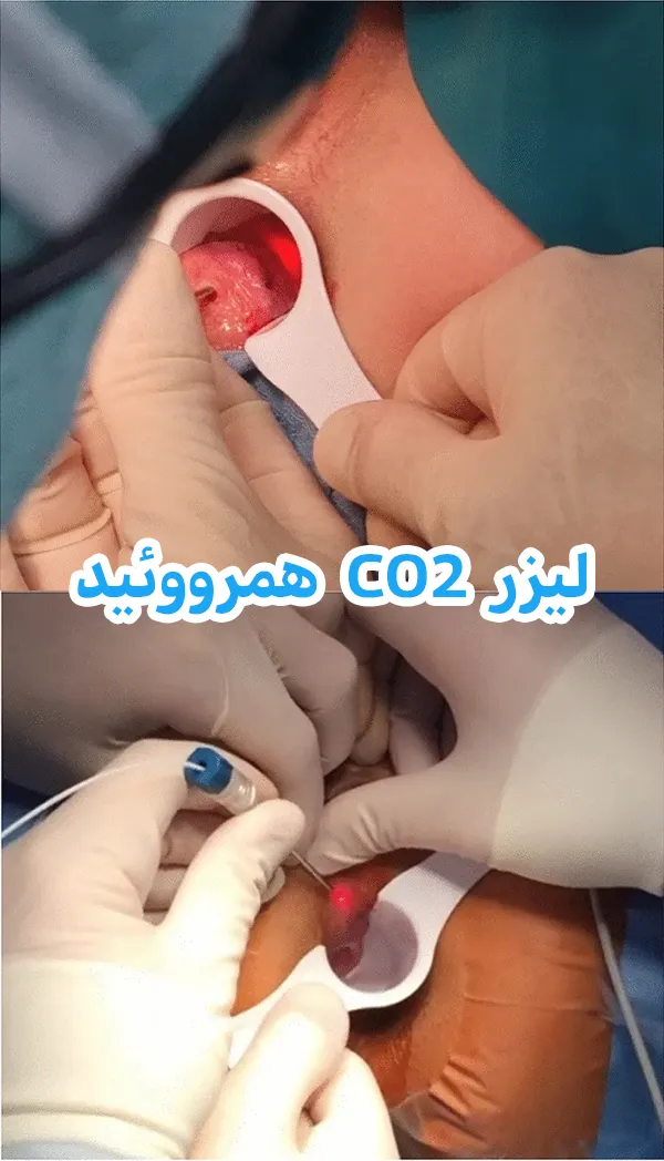 لیزر هموروئید