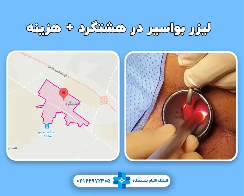 لیزر بواسیر در هشتگرد
