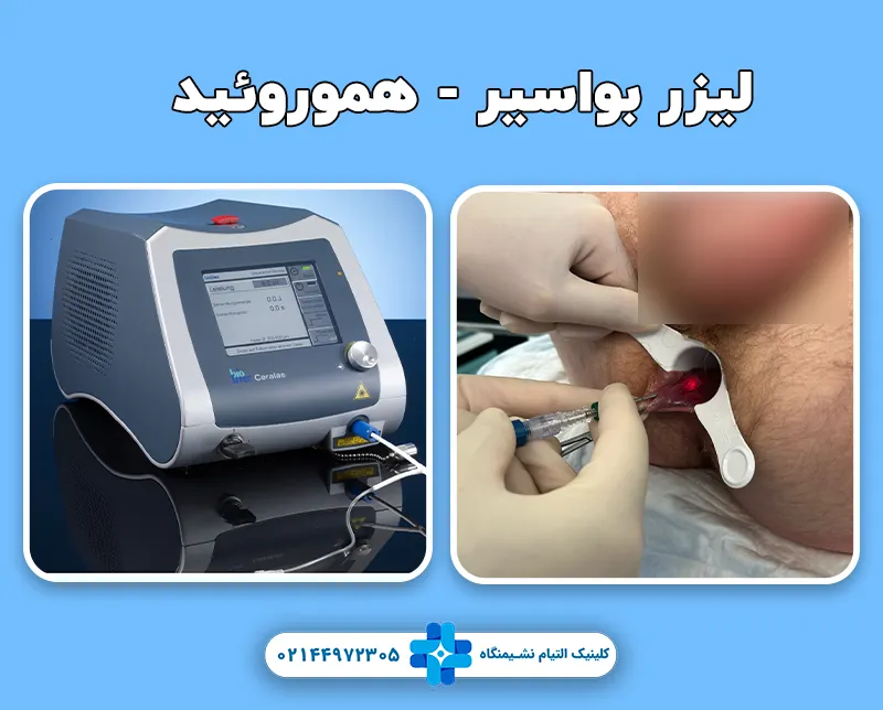 لیزر بواسیر