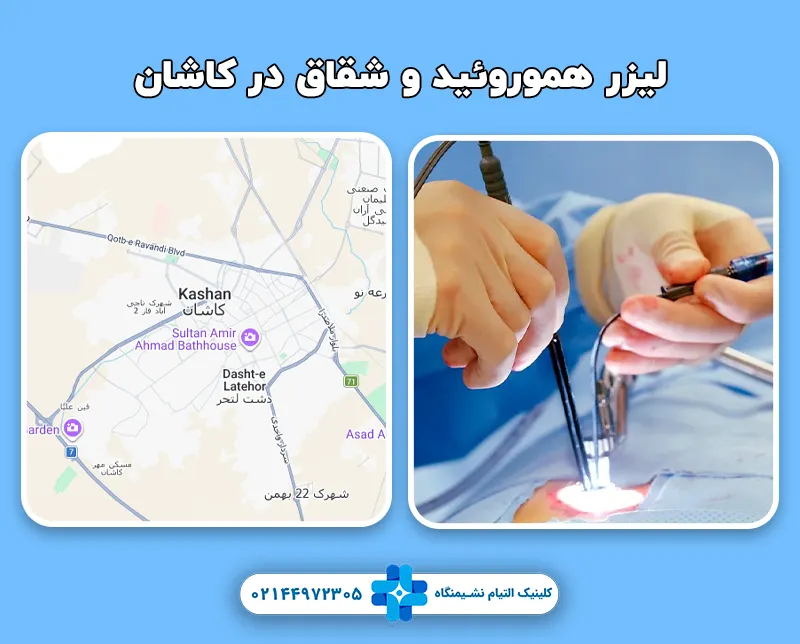 لیزر هموروئید و شقاق در کاشان