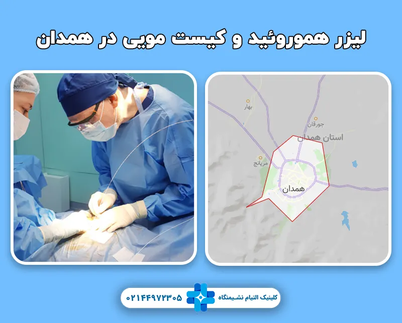 لیزر هموروئید و کیست مویی در همدان