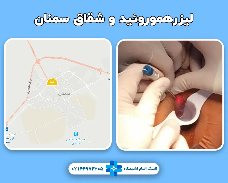 کلینیک درمان هموروئید و شقاق با لیزر در سمنان