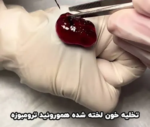 هموروئید ترومبوزه تخلیه شده