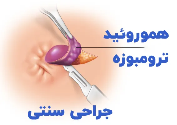 جراحی هموروئید ترومبوزه