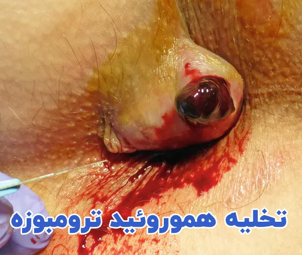 تخلیه هموروئید ترومبوزه