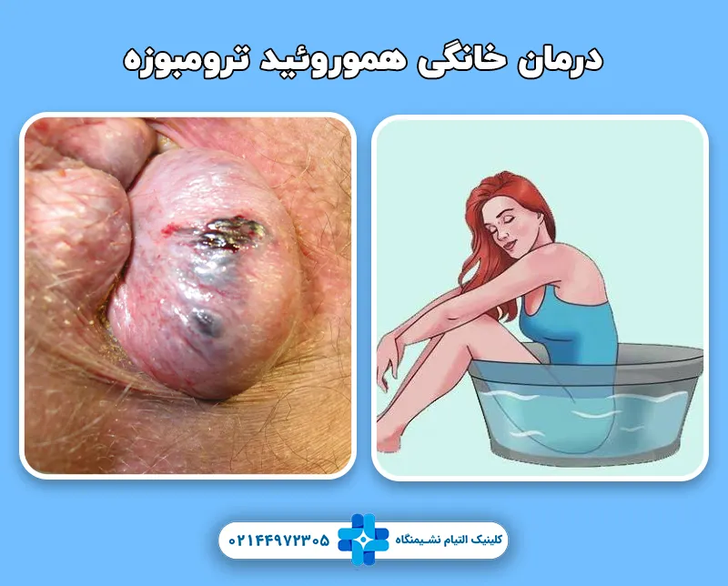 درمان خانگی هموروئید ترومبوزه