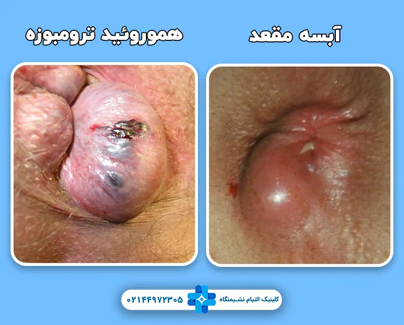 تفاوت هموروئید ترومبوزه و آبسه مقعد