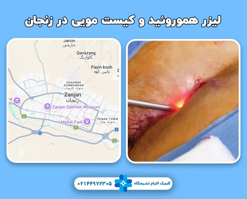 لیزر هموروئید و کیست مویی در زنجان
