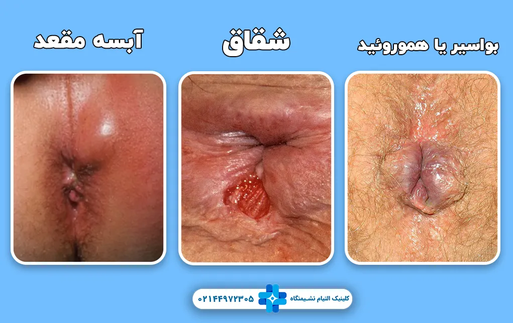تفاوت آبسه مقعدی با شقاق و هموروئید