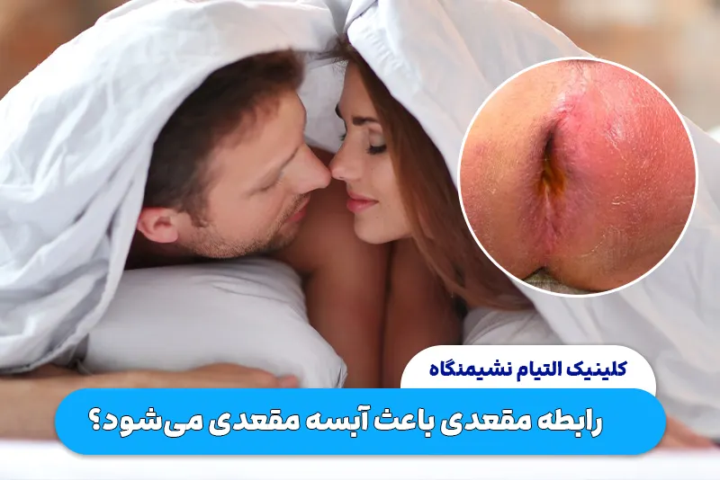 آیا رابطه مقعدی باعث آبسه مقعدی می شود؟