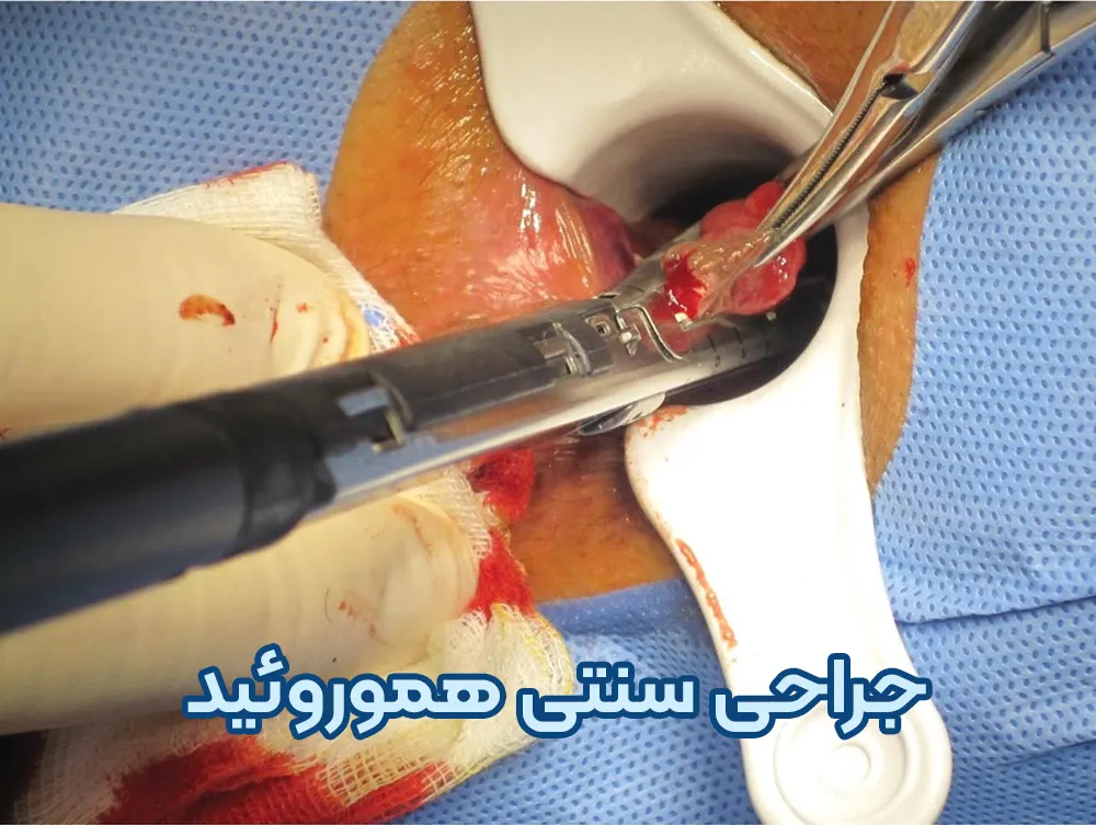 جراحی سنتی هموروئید