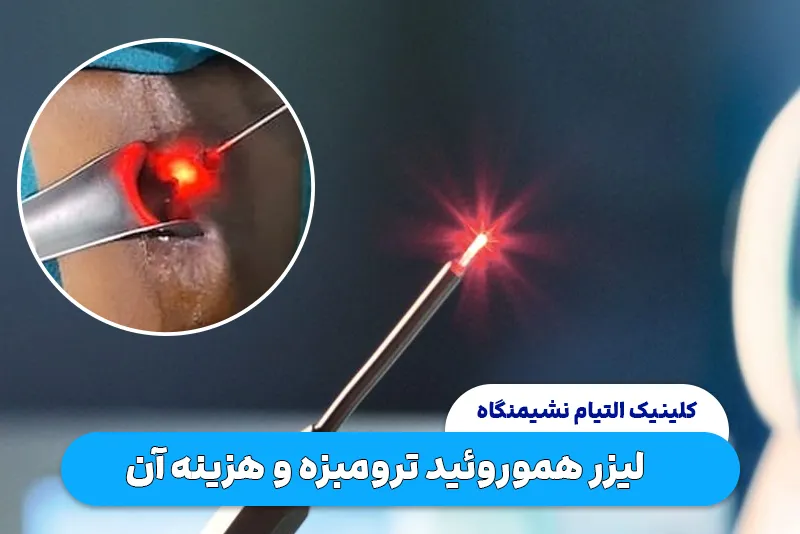 لیزر هموروئید ترومبوزه