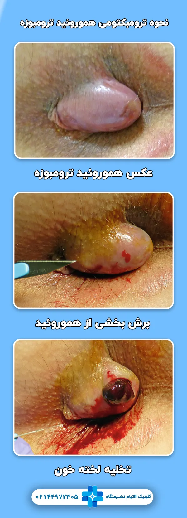 ترومبکتومی