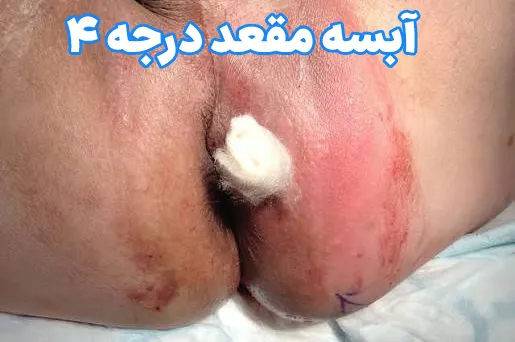 آبسه مقعد شدید
