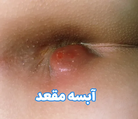 آبسه مقعد