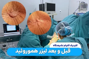 قبل و بعد لیزر هموروئید