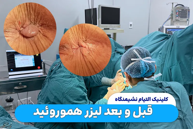 قبل و بعد لیزر هموروئید