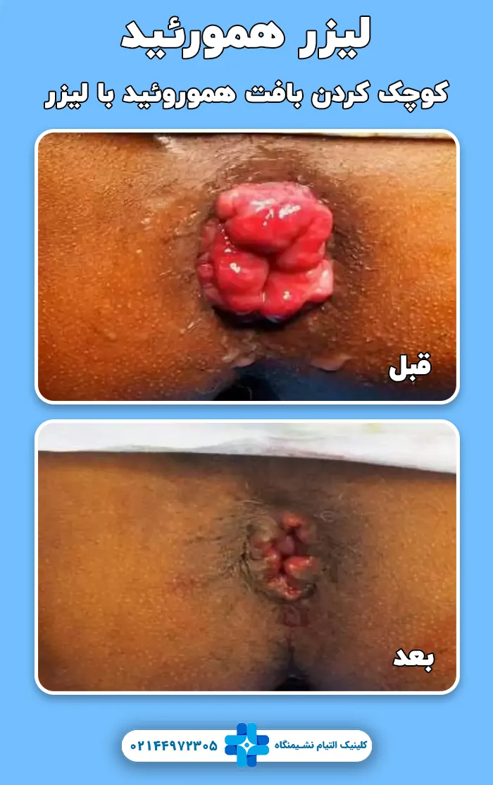 کوچک کردن هموروئید با فیبر لیزر