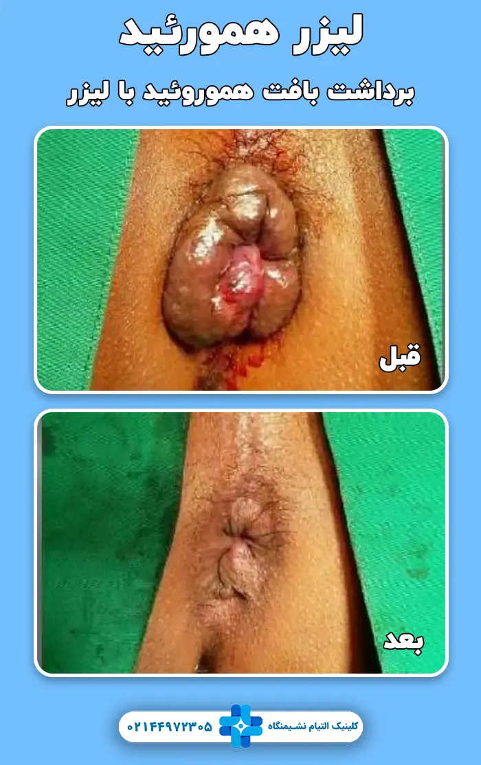 عکس قبل و بعد لیزر هموروئید