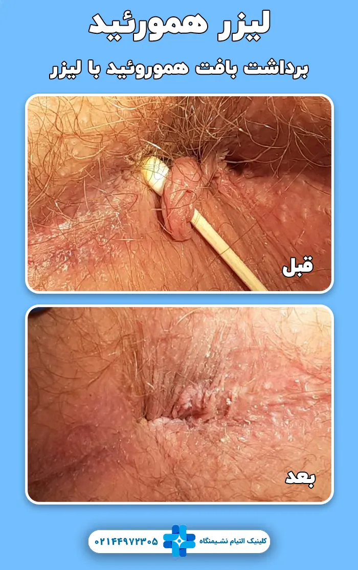 لیزر هموروئید