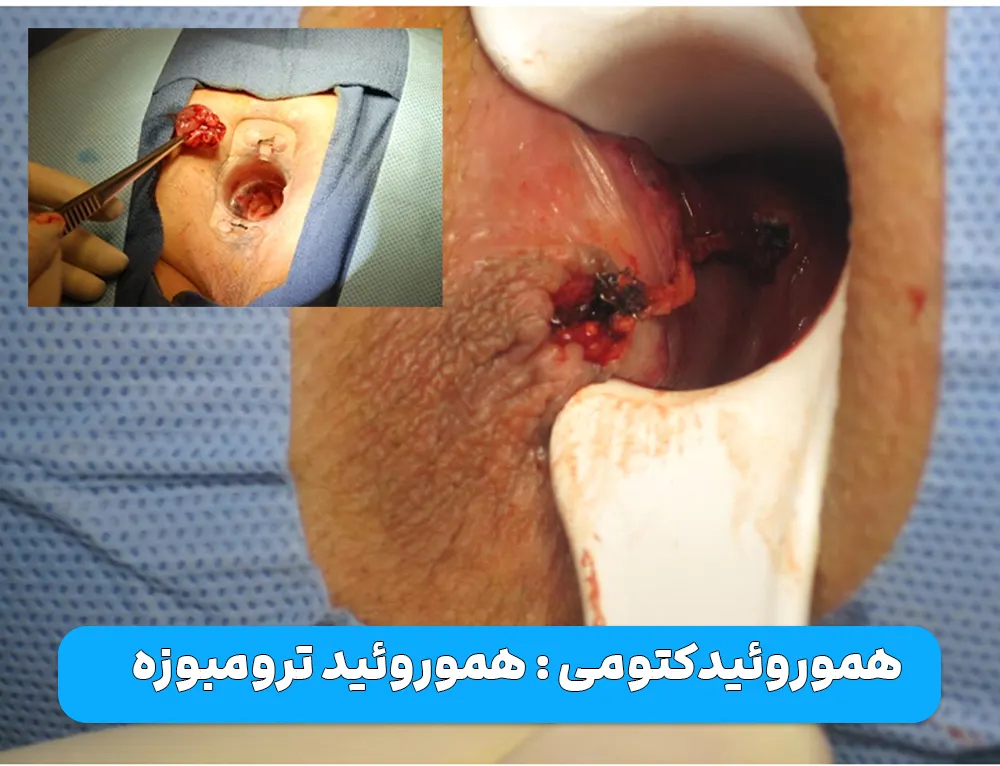 هموروئیدکتومی
