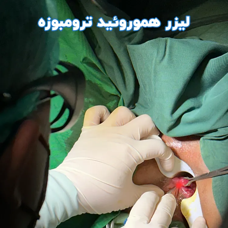 لیزر هموروئید ترومبوزه
