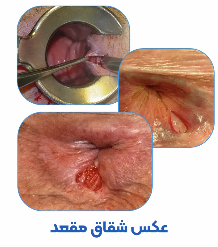 شقاق مقعدی