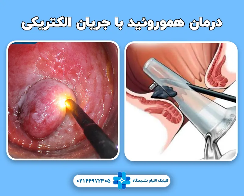 درمان هموروئید با جریان الکتریکی