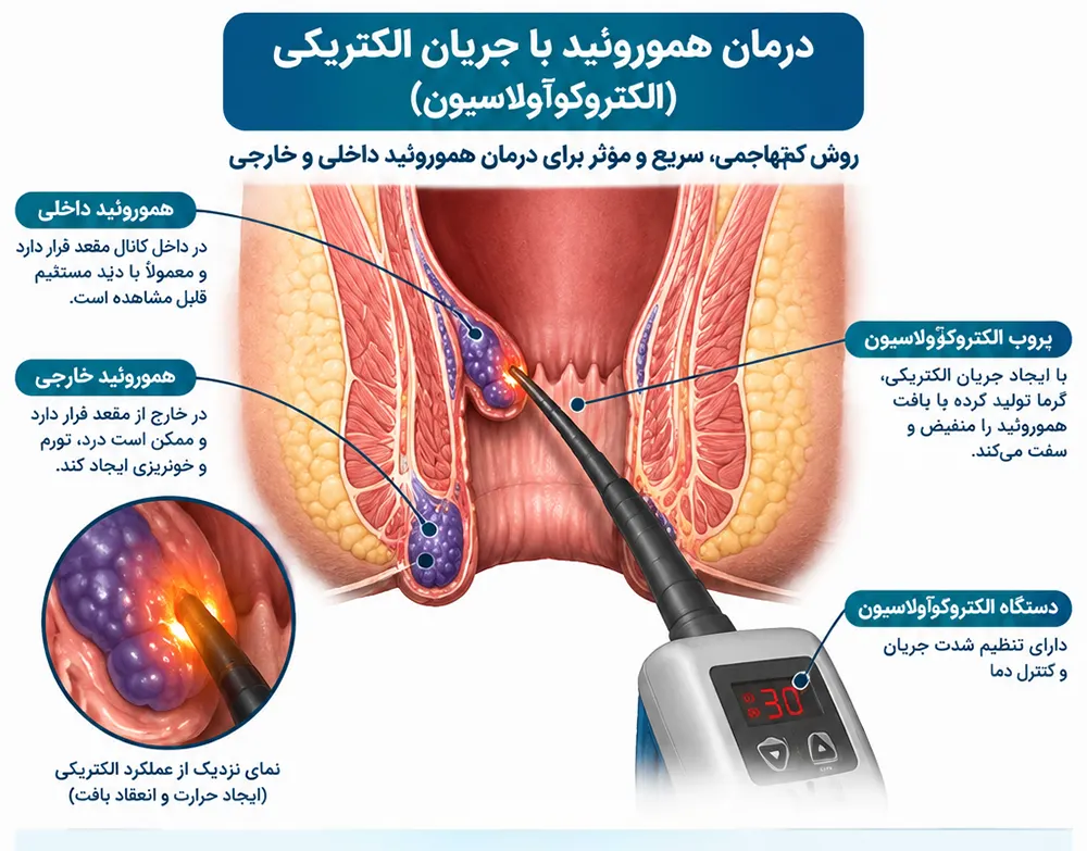 درمان هموروئید با جریان الکتریکی
