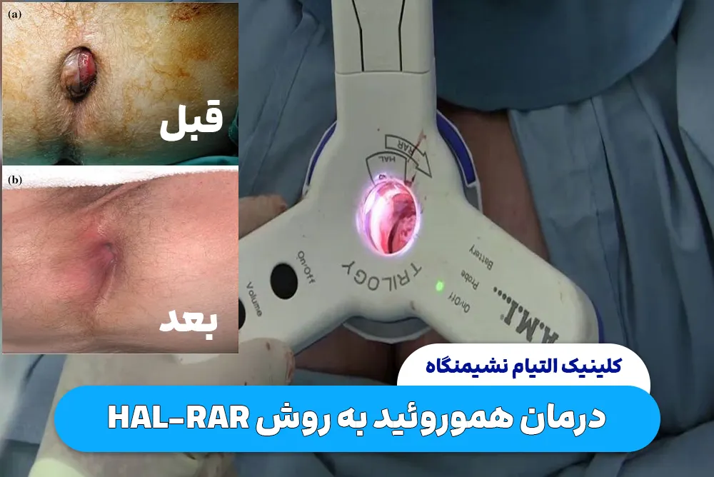 درمان هموروئید به روش HAL-RAR