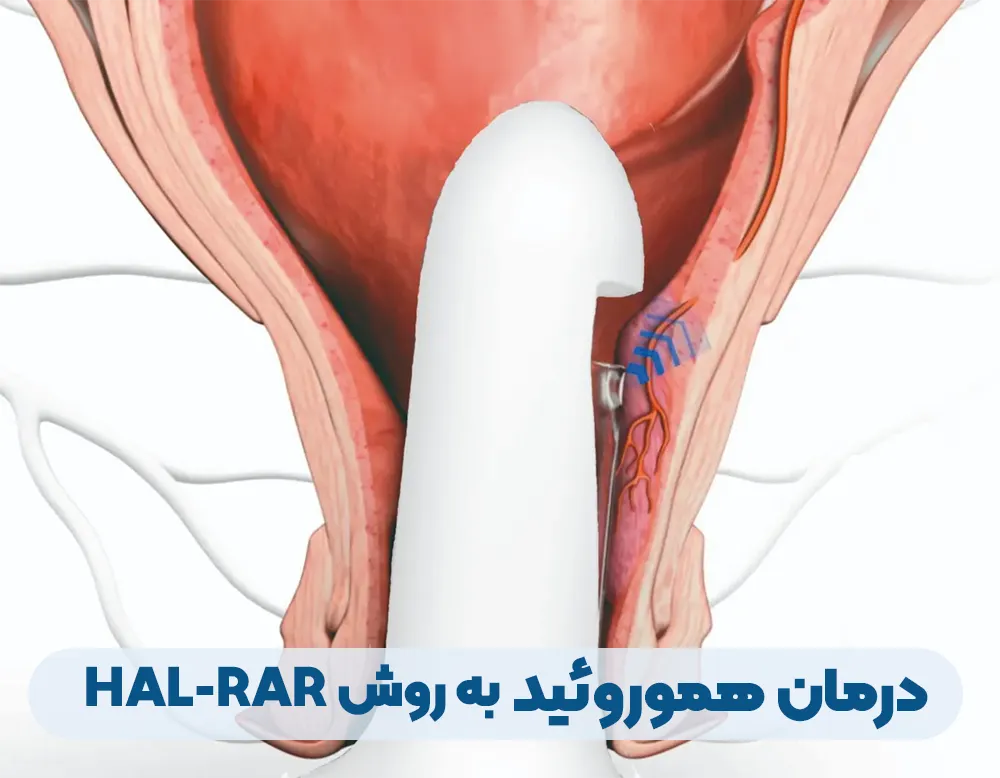 عمل HAL-RAR