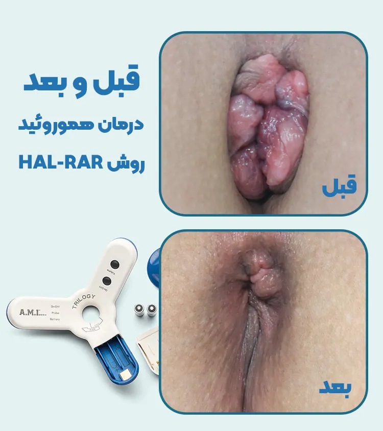 قبل و بعد درمان هموروئید به روش HAL-RAR