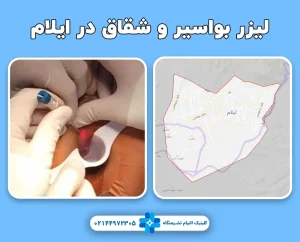 کلینیک لیزر بواسیر و شقاق در ایلام