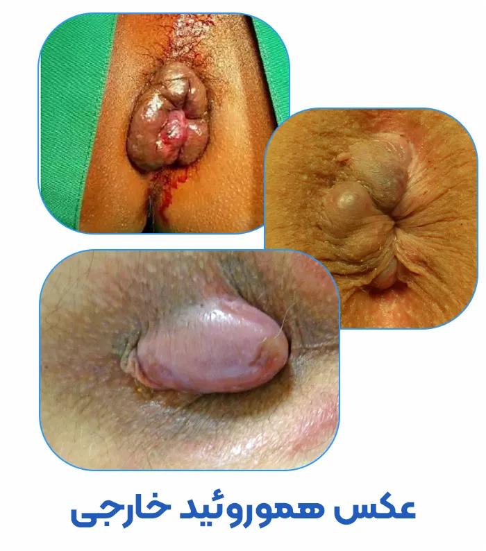 هموروئید یا بواسیر
