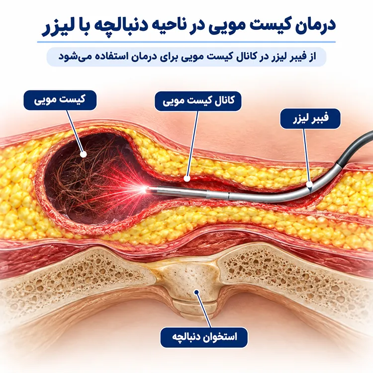 درمان تخصصی کیست مویی با لیزر CO2