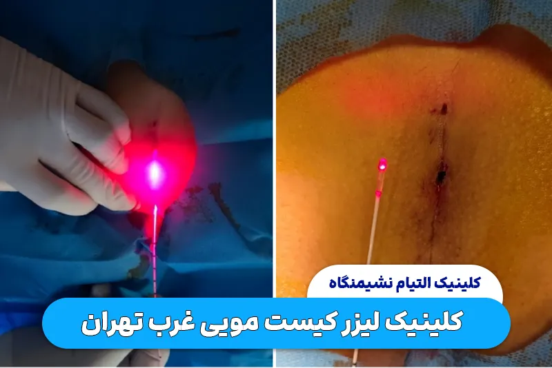 کلینیک درمان کیست مویی با لیزر در غرب تهران
