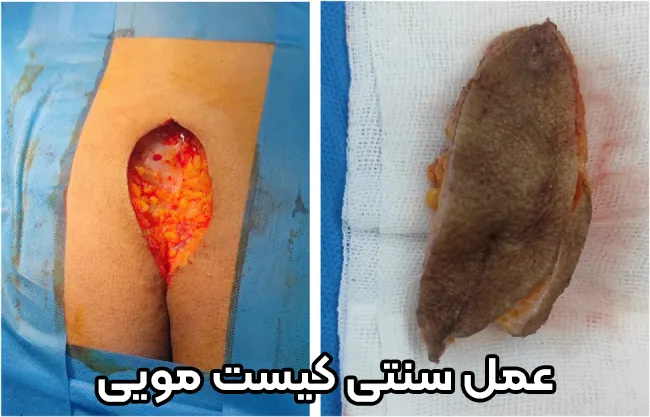 جراحی غیر لیزری کیست مویی