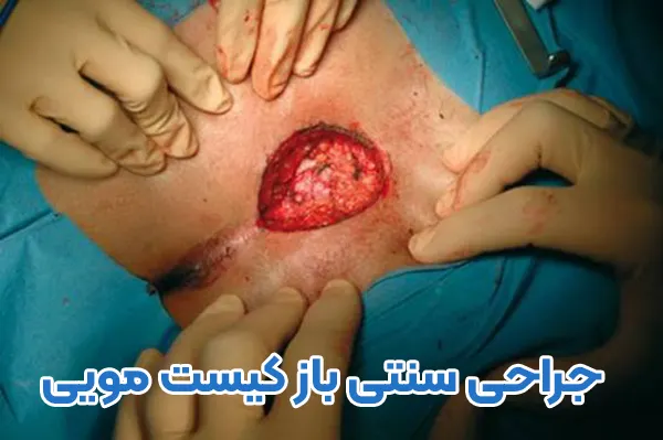 عمل باز کیست مویی