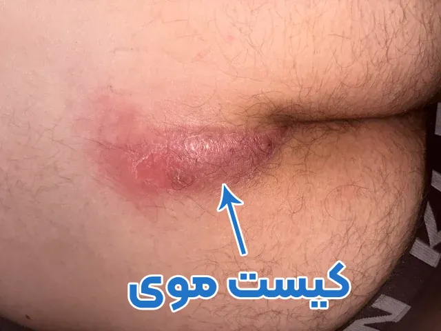 کیست مویی
